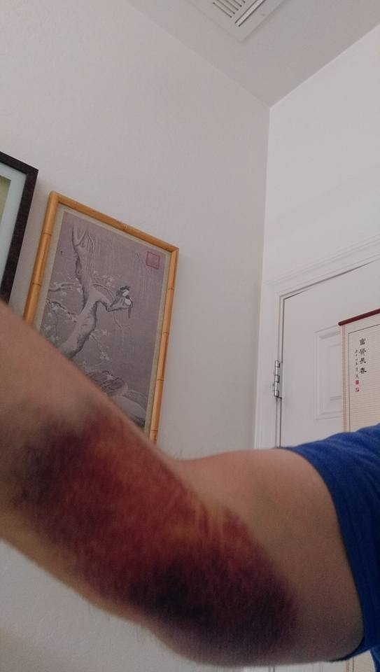 Muh arm!