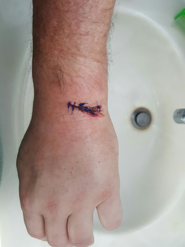 Stitches